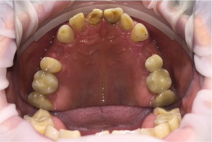 Восстановление боковых зубов с помощью имплантатов и последующее протезирование с помощью коронок