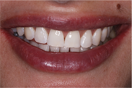 Клиническое отбеливание зубов с помощью ZOOM 4