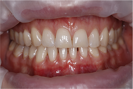 Клиническое отбеливание зубов с помощью ZOOM 4