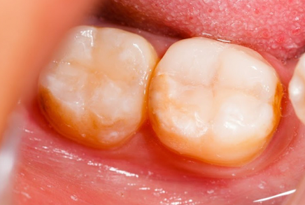 Лечение трех- и четырех- канальных зубов и последующее их пломбирование